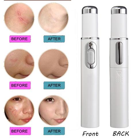 Blue Light Therapy Acne